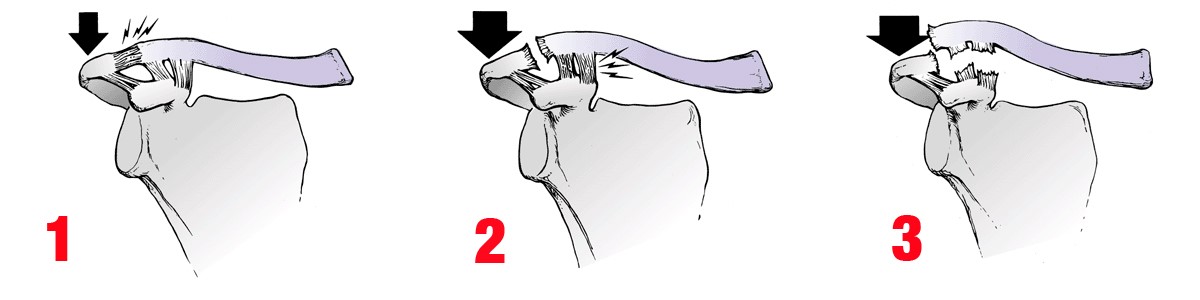 Arthropathie Acromio Claviculaire Swiss Shoulder Clinic